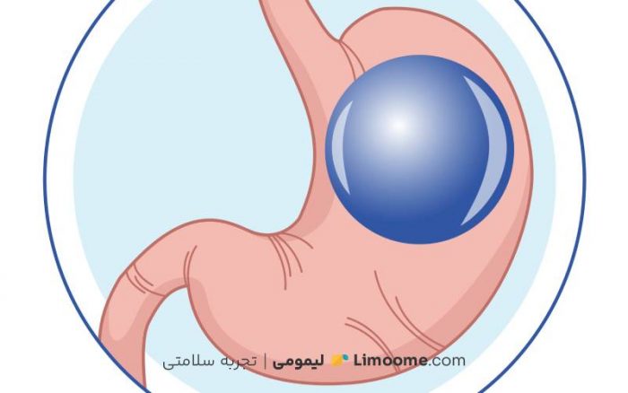 عمل بالن معده چیست + مزایا و معایب