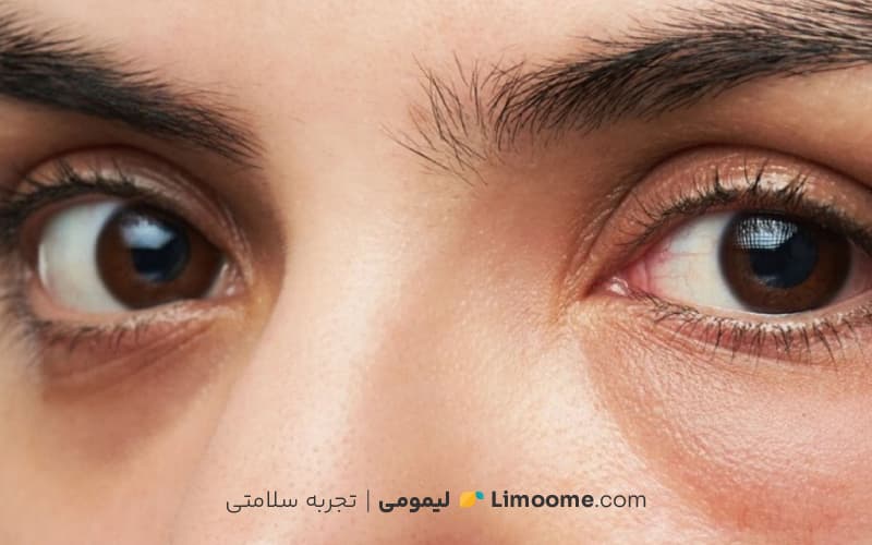 درمان‌های دارویی گودی زیر چشم