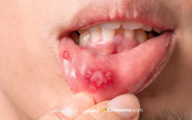 برای درمان آفت دهان چه بخوریم؟
