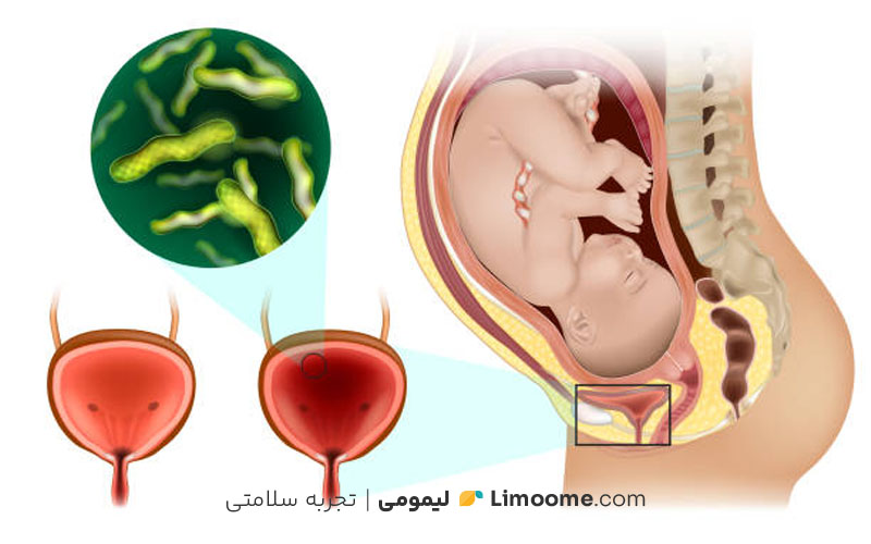 عفونت ادرار در بارداری