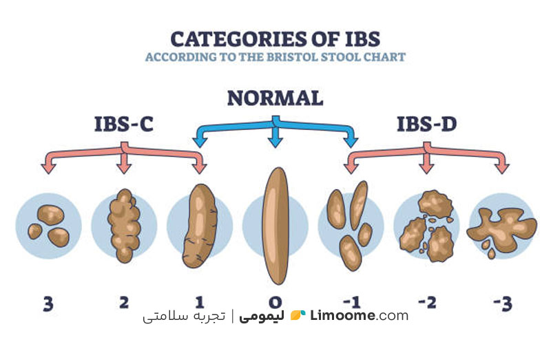 سندروم روده تحریک‌پذیر چیست